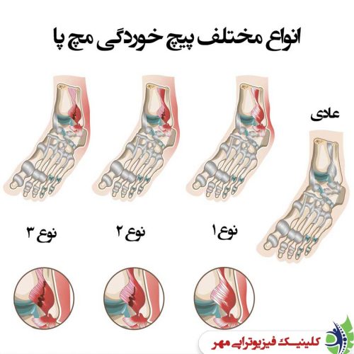 درجات آسیب پیچ خوردگی مچ پا